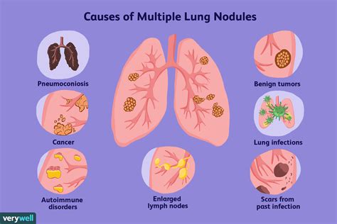 Common Causes of Multiple Lung Nodules .